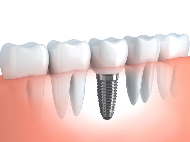 Dental Implants Hingham, MA