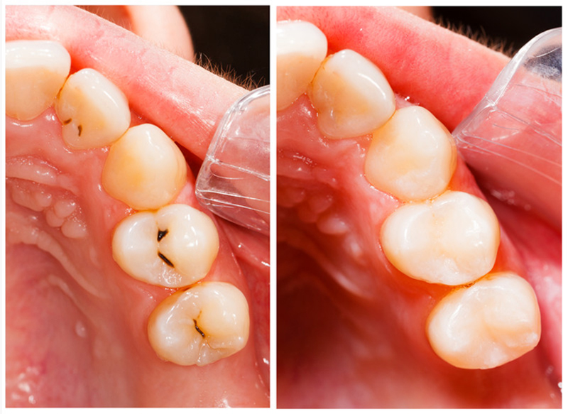 Fillings Hingham, MA