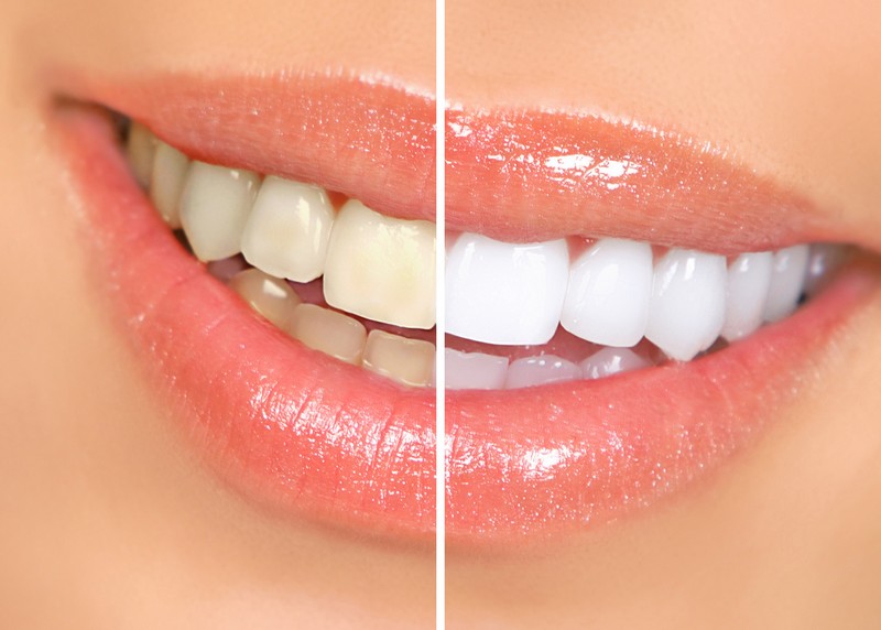 Teeth Whitening Hingham, MA