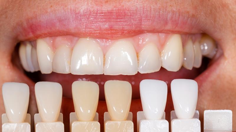 Veneers Hingham, MA