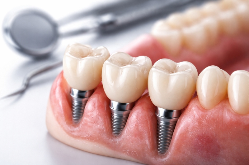 Implant Restorations in Hingham, MA 