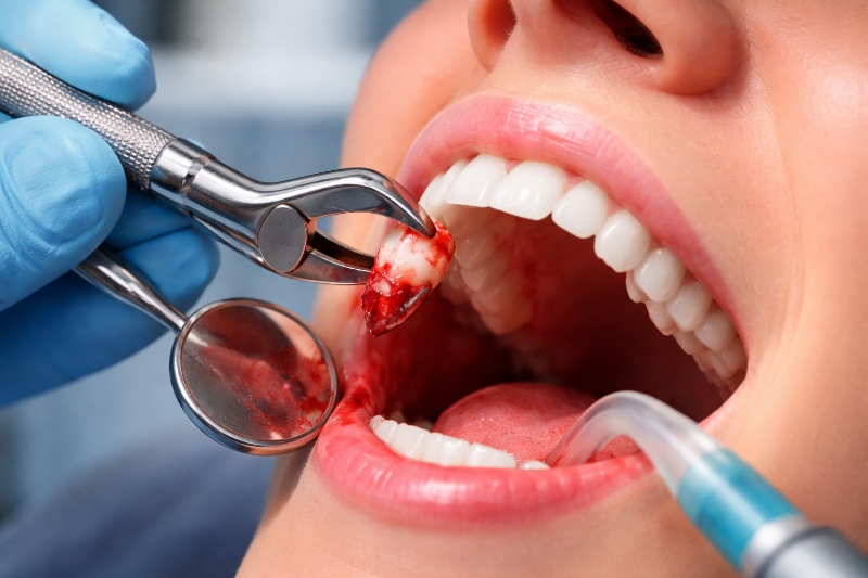 Tooth Extractions in Hingham, MA 